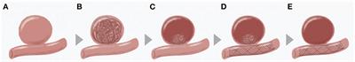 Coiling followed by staged flow diversion for large and giant intracranial aneurysms